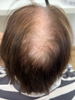 Cómo cubrir pequeñas zonas sin pelo en mujeres